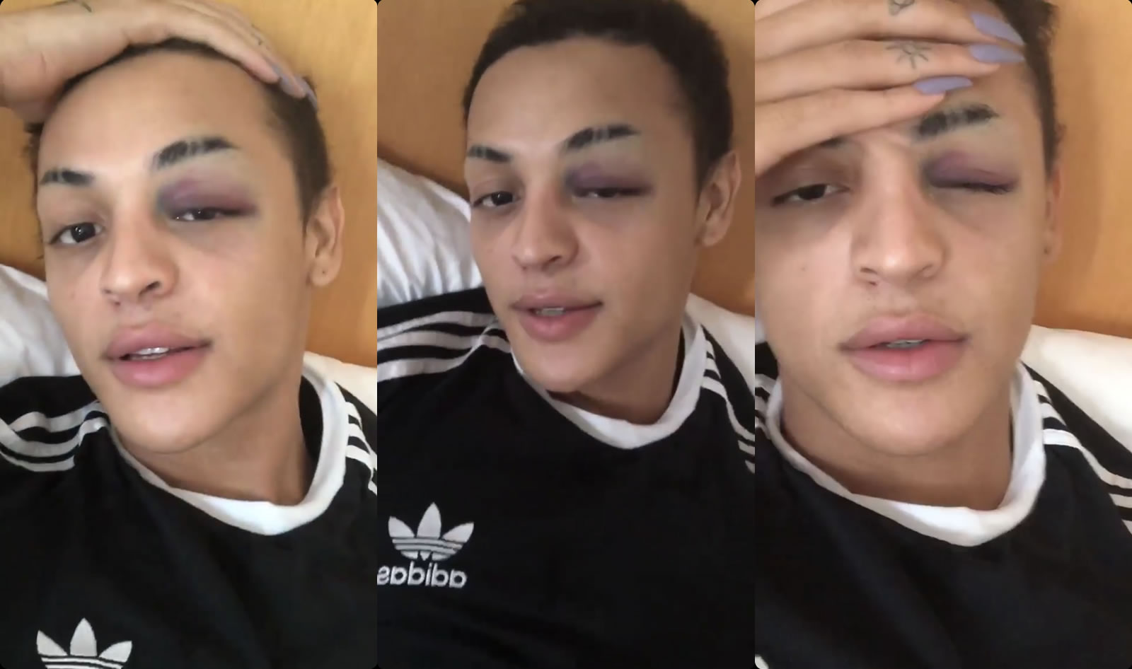 Pabllo Vittar dá joelhada em seu próprio rosto e adia gravação de clipe. (Foto: Reprodução/Instagram)